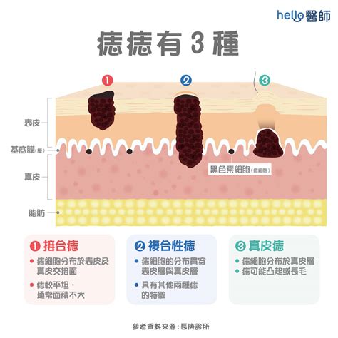 下巴痣長毛|痣形成的原因？痣長毛、痣變多變大是痣病變？5招判。